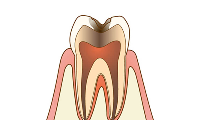 C3：感染歯質が2層目の象牙質深部または髄腔（神経の中）内まで達した状態